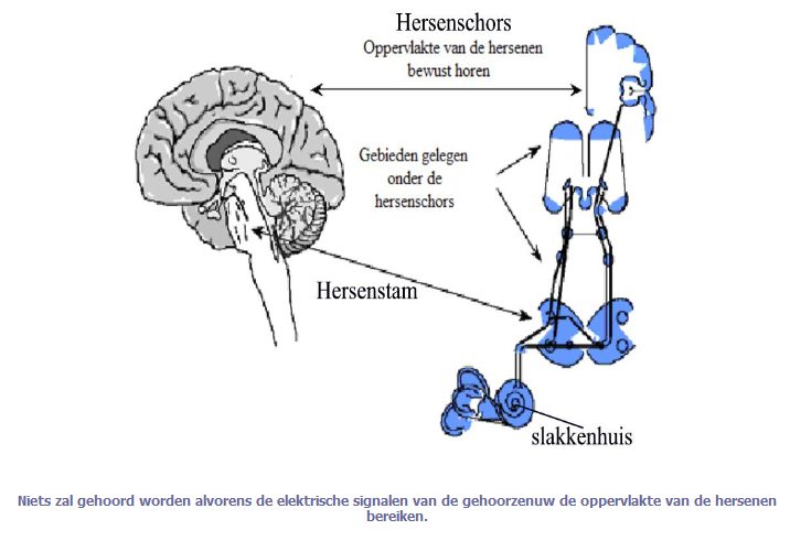Hyperacusis: wat gebeurt er in de hersenen?